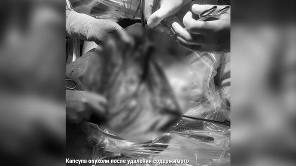 Maye çıxarıldıqdan sonra qalan şişin kapsulu 